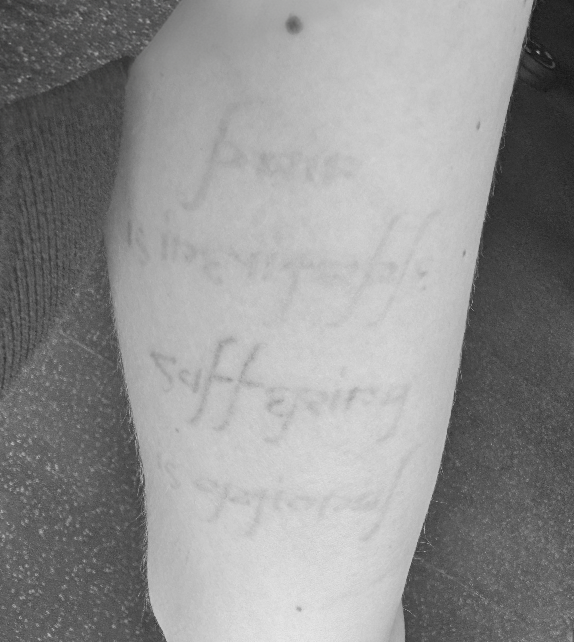 Four days after laser removal