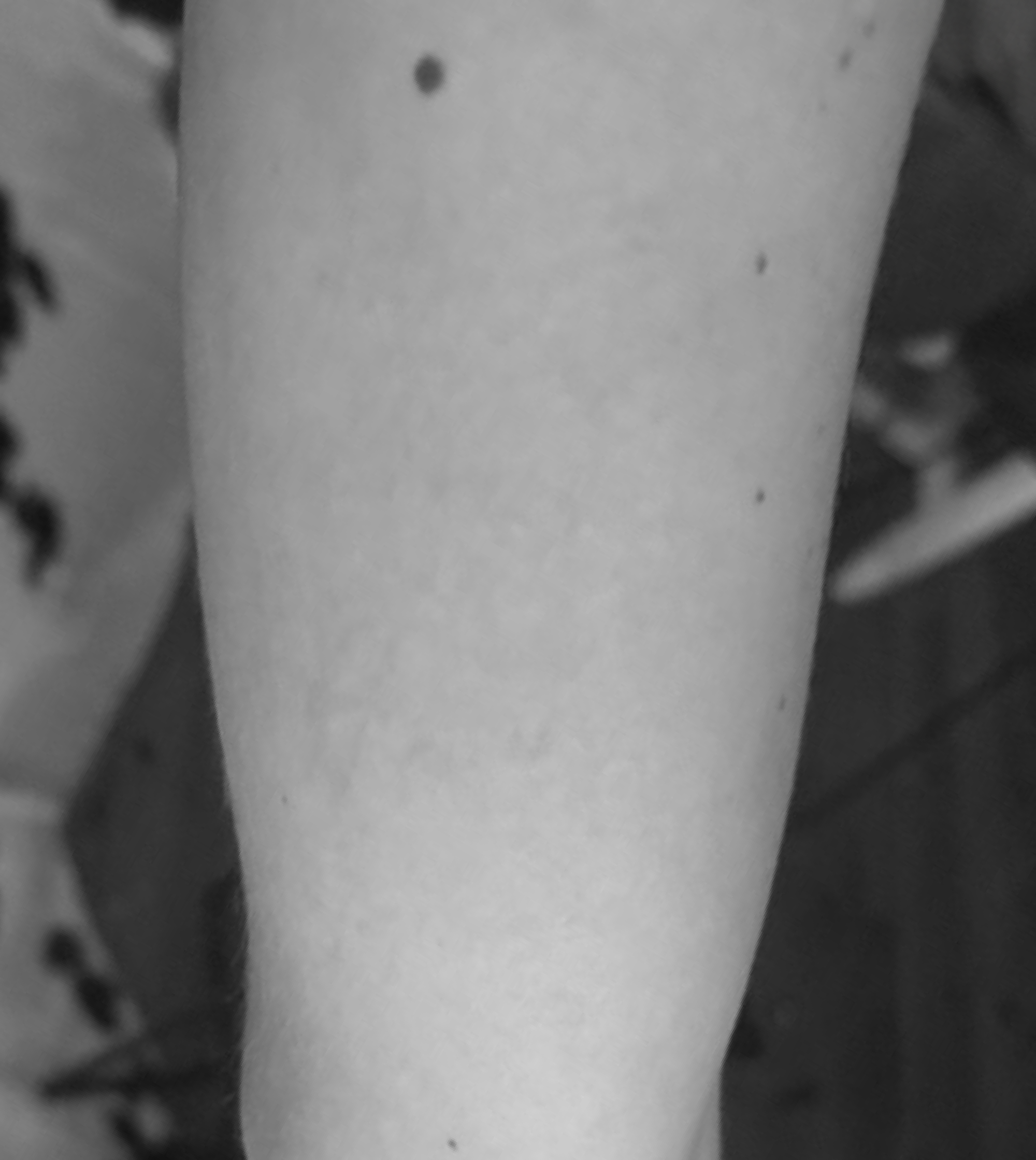 Three months after laser removal